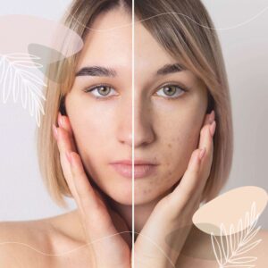 ACNE TREATMENTS_www.spa-argans.com