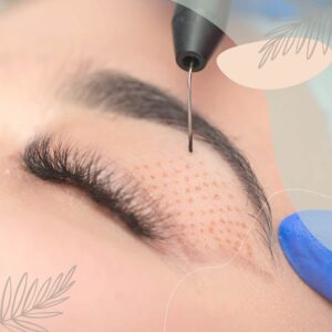 DERMA PEN FIBROBLAST_www.spa-argans.com